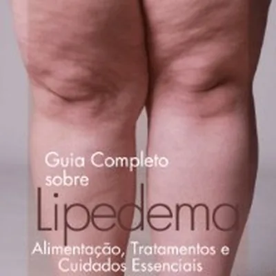 Capa de Guia Completo sobre Lipedema: alimentação, tratamentos e cuidados